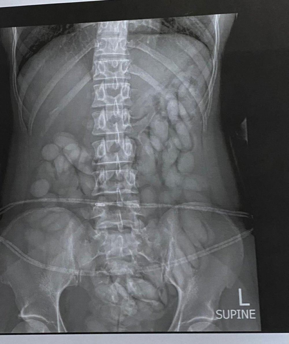 20240925_235950 Drug in stomach